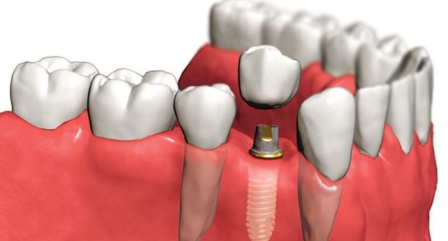 Преимущества зубных имплантов