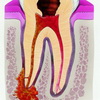 Что такое киста зуба и как с ней бороться?